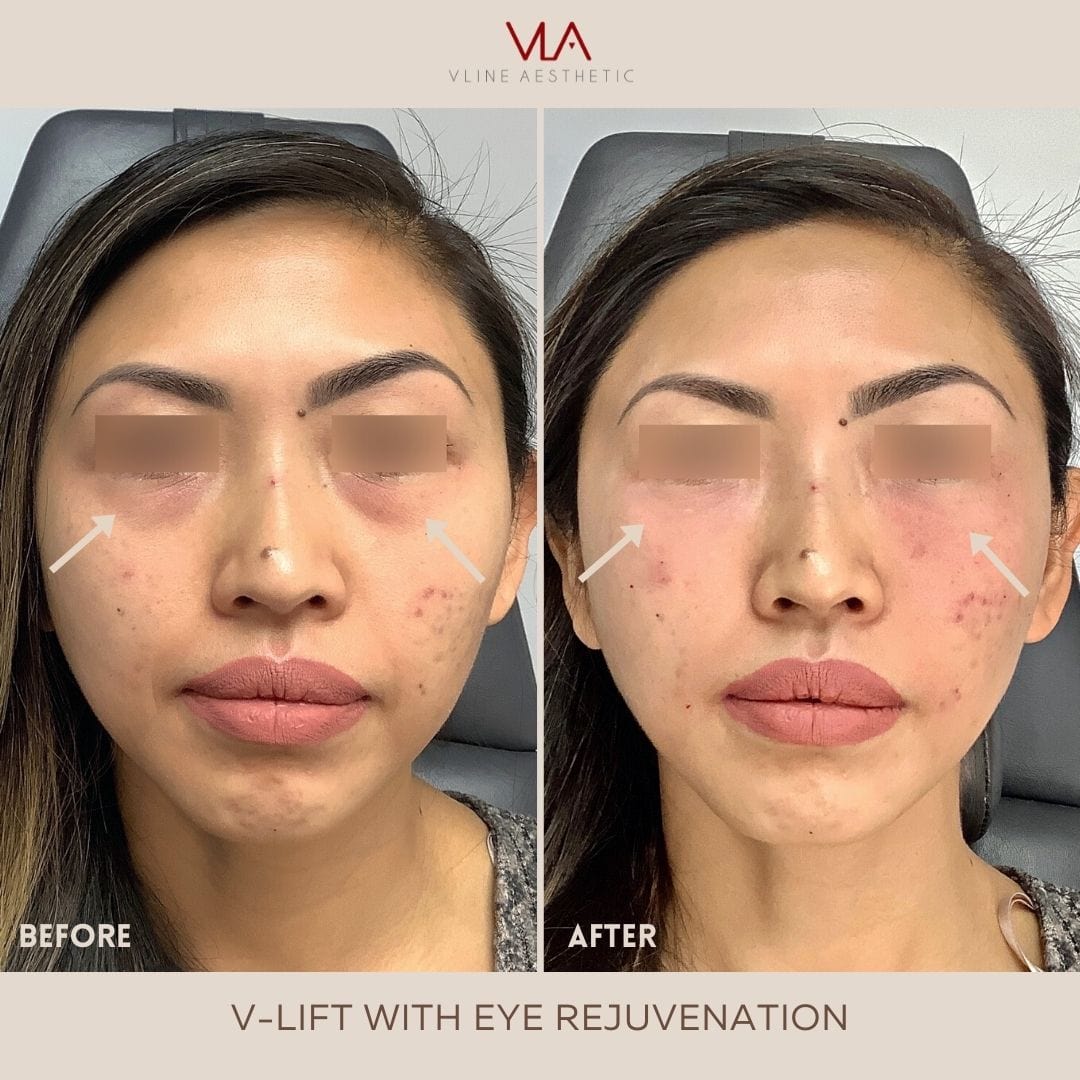 Collagen Lift - Skin Perfect Brothers Powered by VLA