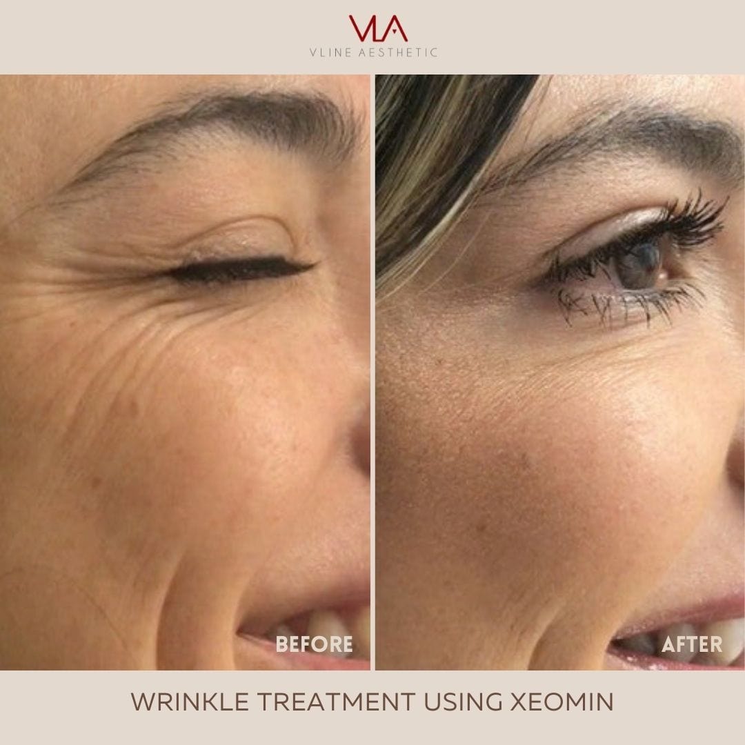 XEOMIN / JEUVEAU - Skin Perfect Brothers Powered by VLA