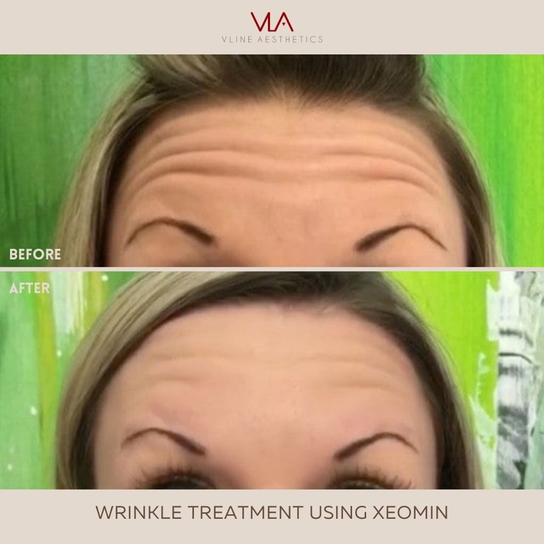XEOMIN / JEUVEAU - Skin Perfect Brothers Powered by VLA