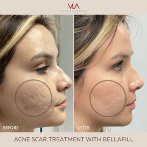 Acne Scars / 1 Bellafill - Skin Perfect Brothers Powered by VLA