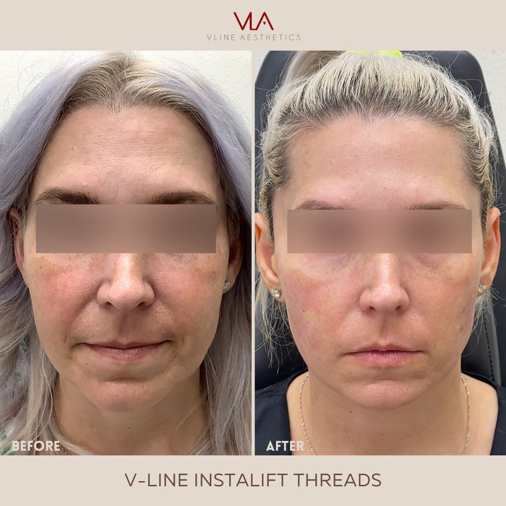 Before And Afters Skin Perfect Brothers Powered By Vla