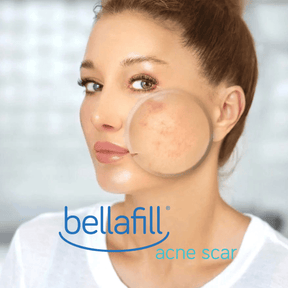 Acne Scars / 1 Bellafill