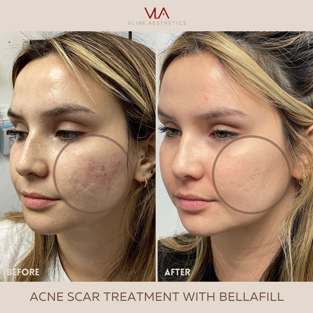 Acne Scars / 1 Bellafill