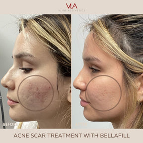 Acne Scars / 1 Bellafill