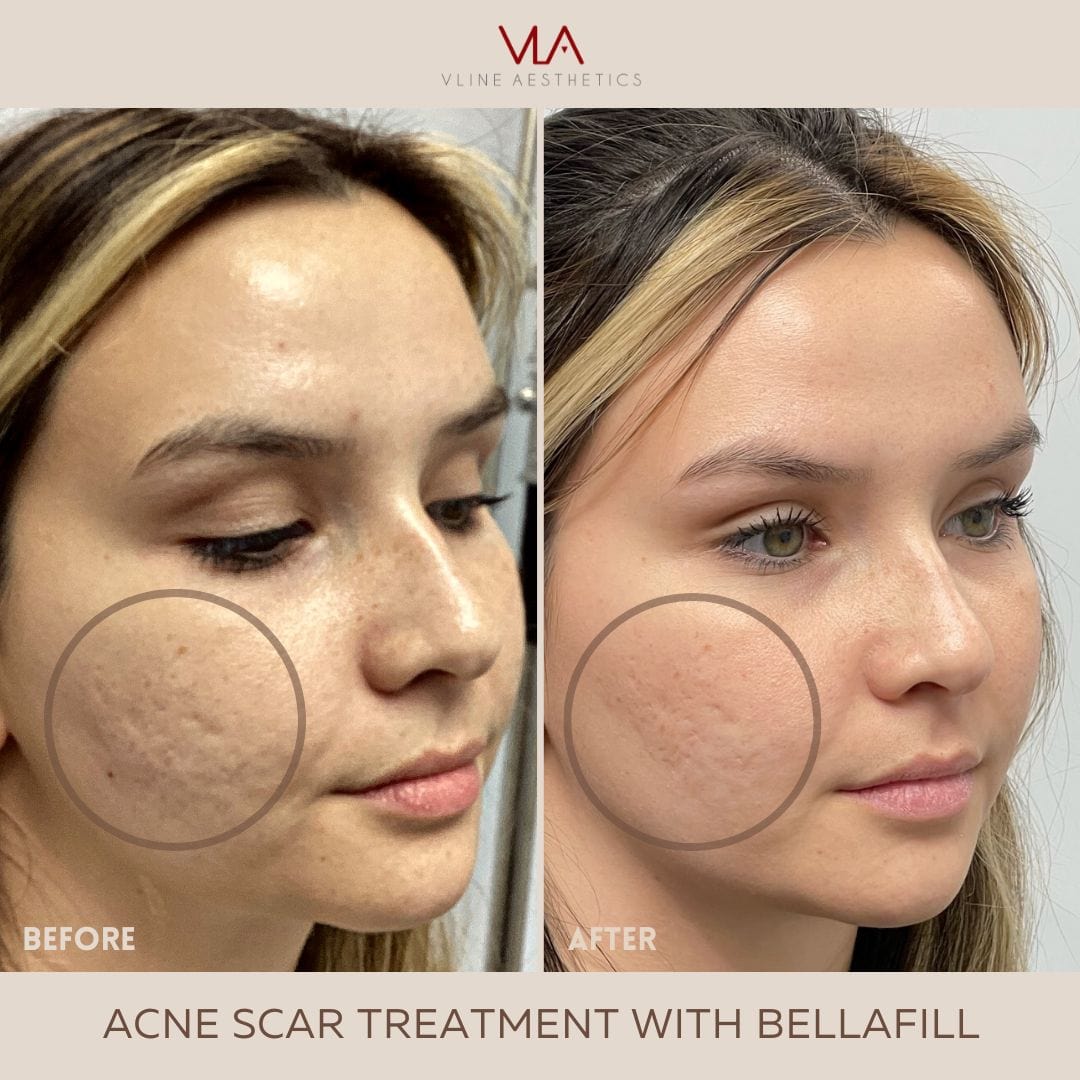 Acne Scars / 1 Bellafill