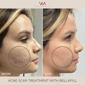 Acne Scars / 1 Bellafill