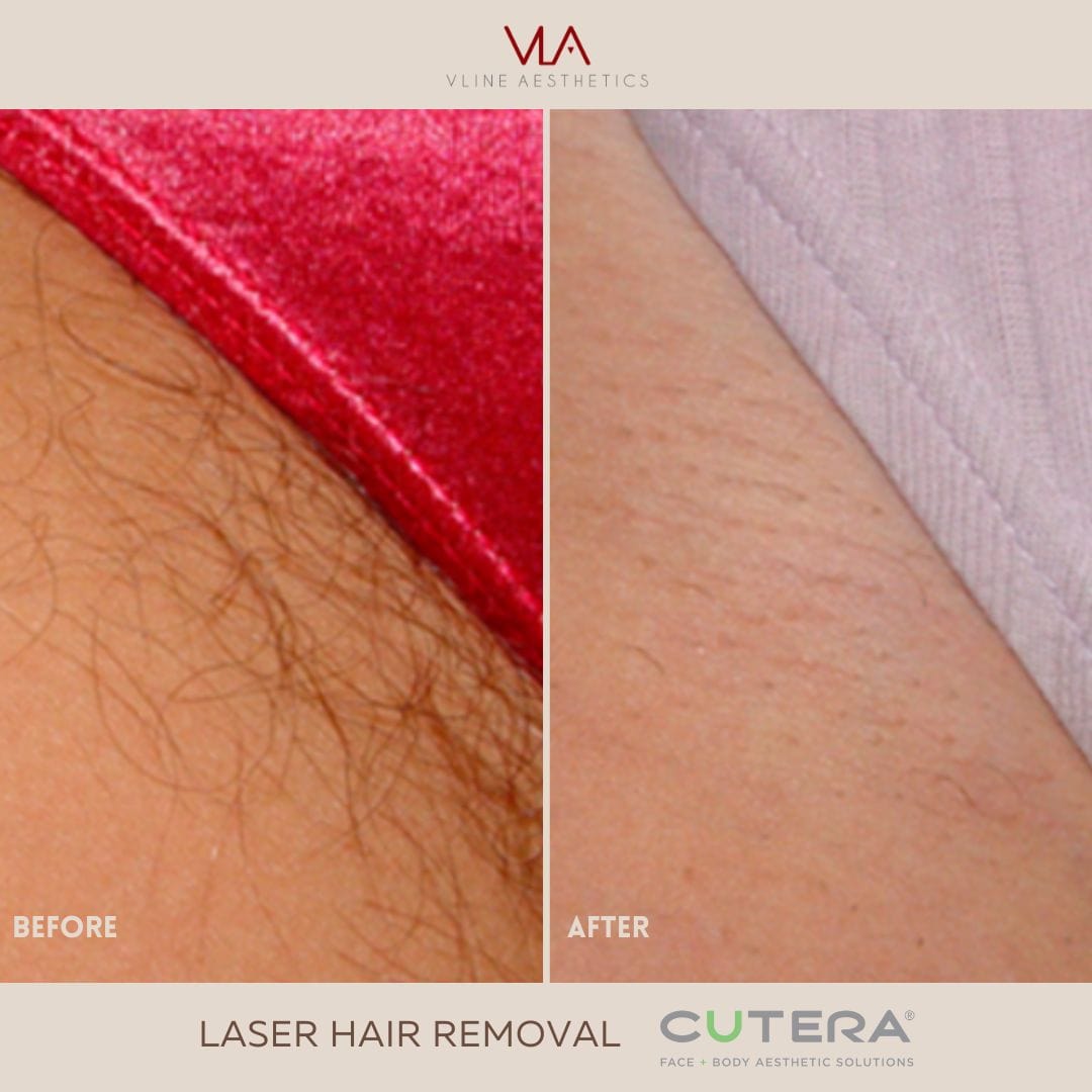 Laser Hair Removal - Skin Perfect Brothers Powered by VLA