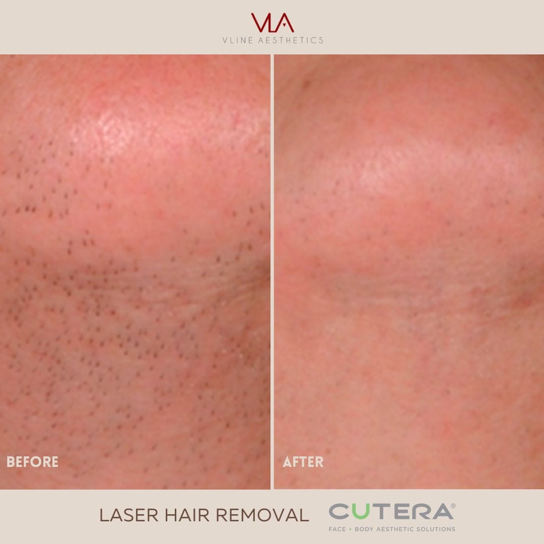 Laser Hair Removal - Skin Perfect Brothers Powered by VLA