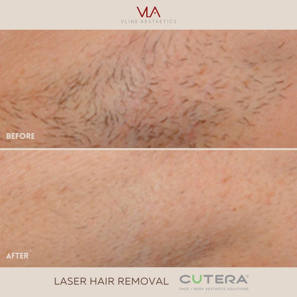 Laser Hair Removal - Skin Perfect Brothers Powered by VLA