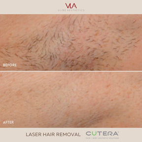 Laser Hair Removal - Skin Perfect Brothers Powered by VLA