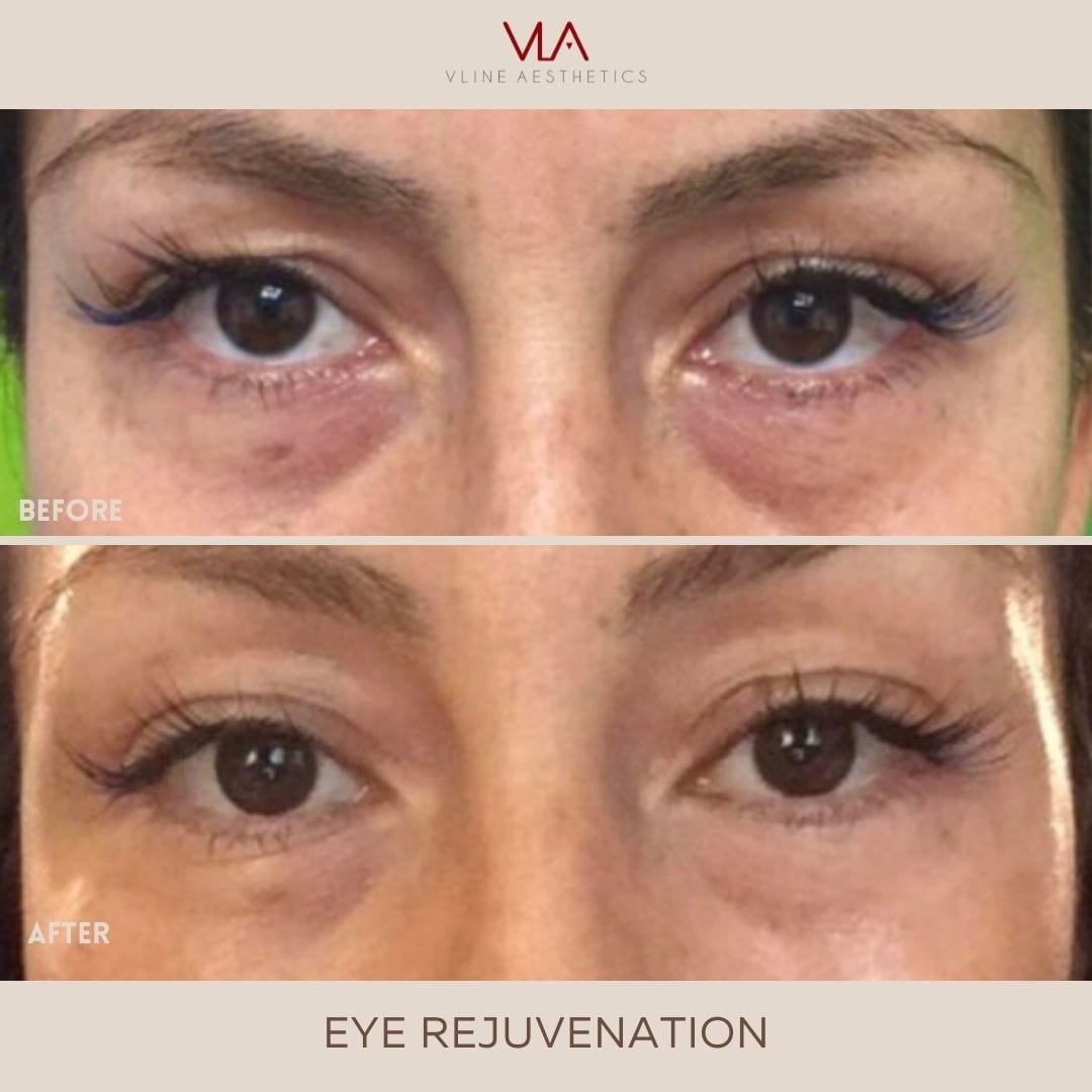 Eye Rejuvenation (Comfort Blend) - Skin Perfect Brothers Powered by VLA