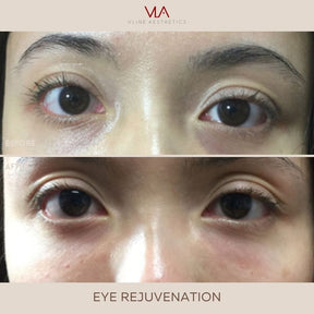 Eye Rejuvenation (Comfort Blend) - Skin Perfect Brothers Powered by VLA