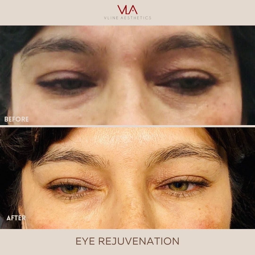 Eye Rejuvenation (Comfort Blend) - Skin Perfect Brothers Powered by VLA