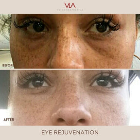 Eye Rejuvenation (Comfort Blend) - Skin Perfect Brothers Powered by VLA