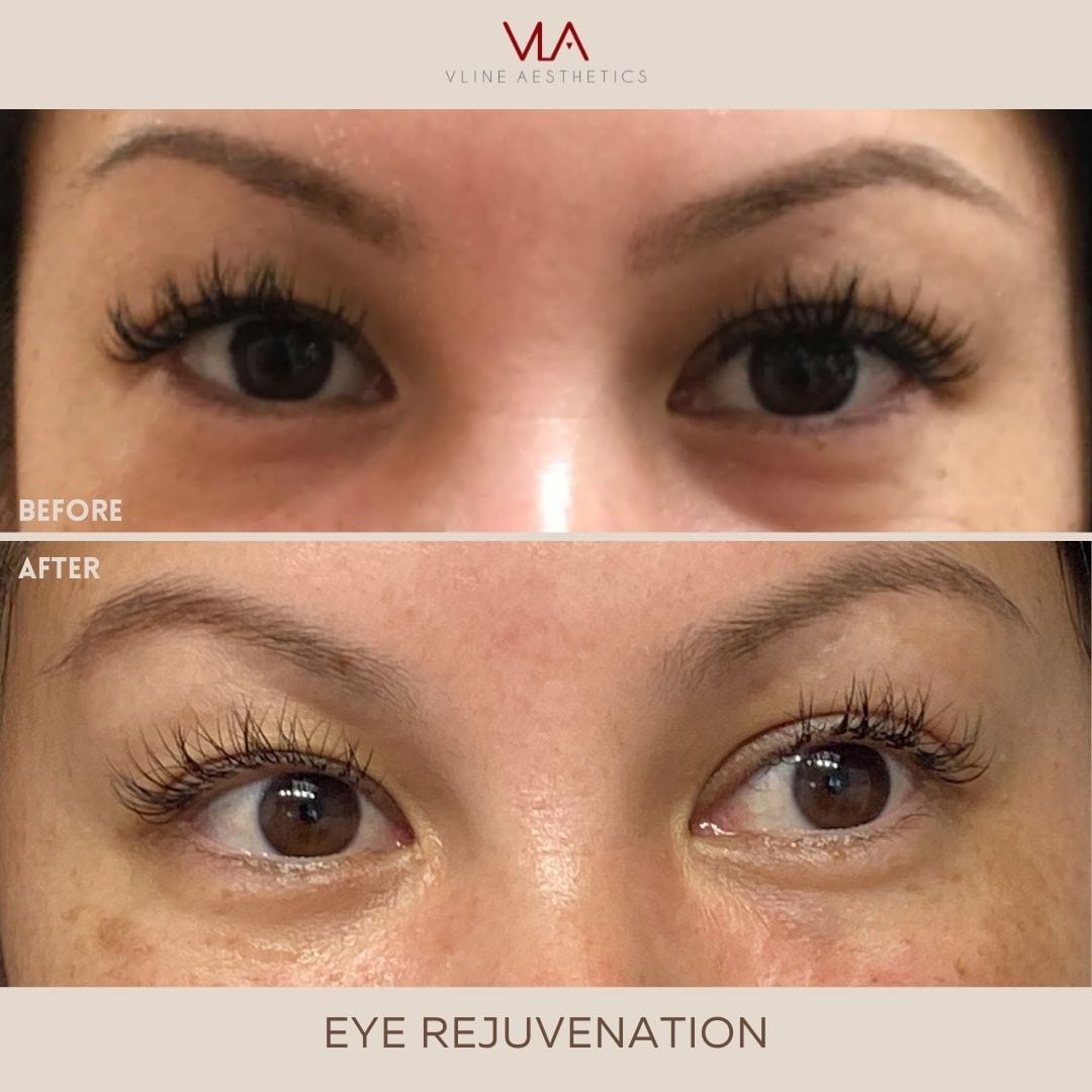 Eye Rejuvenation (Comfort Blend) - Skin Perfect Brothers Powered by VLA