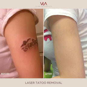 Tattoo Removal - Skin Perfect Brothers Powered by VLA