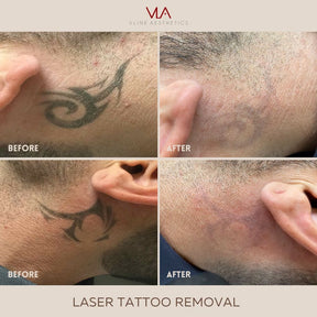 Tattoo Removal - Skin Perfect Brothers Powered by VLA