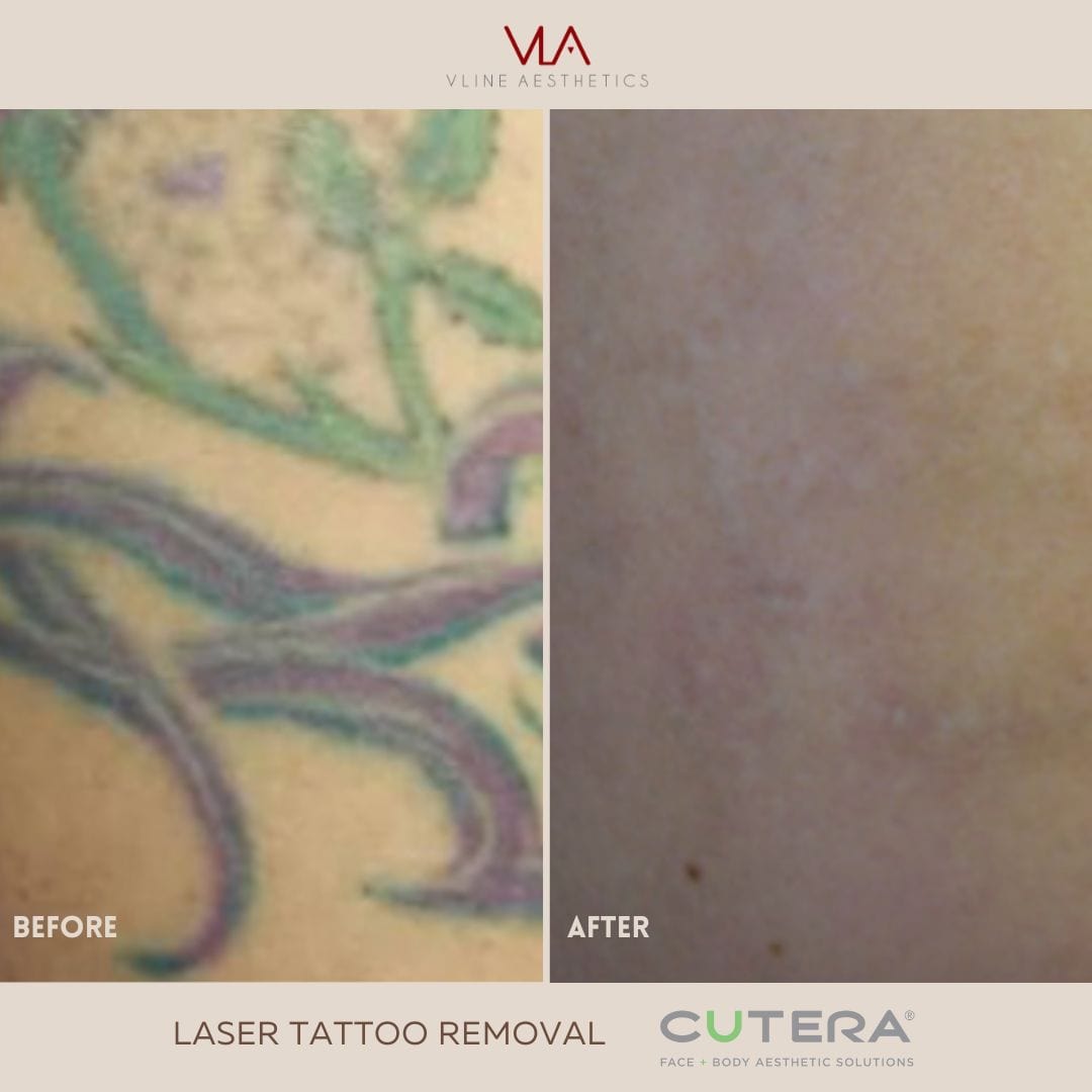 Tattoo Removal - Skin Perfect Brothers Powered by VLA