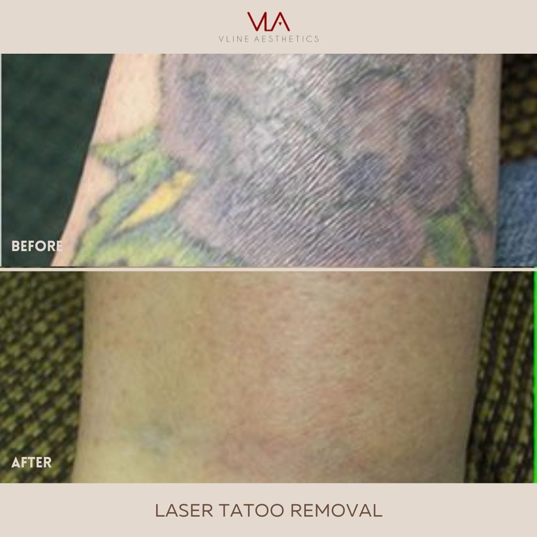 Tattoo Removal - Skin Perfect Brothers Powered by VLA