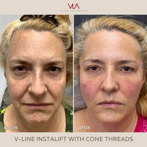 InstaLift Cone Thread / Collagen Boosting Instalift + Free Jawline Toxin Lift (20 Units)