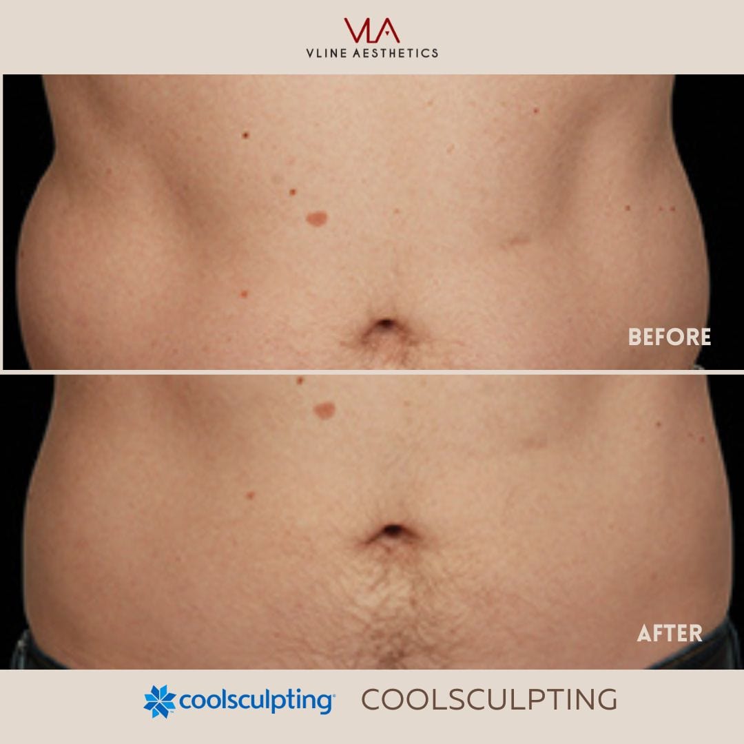 Coolsculpting Body Sculpting Skin Perfect Brothers Powered by VLA