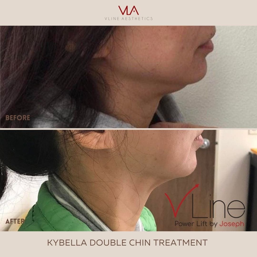 Kybella Treatment - Skin Perfect Brothers Powered by VLA