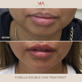 Kybella Treatment - Skin Perfect Brothers Powered by VLA