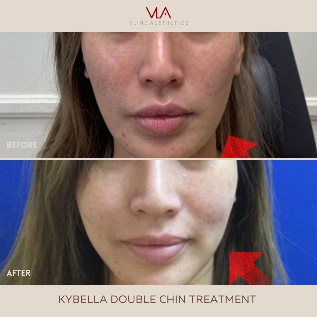 Kybella Treatment - Skin Perfect Brothers Powered by VLA