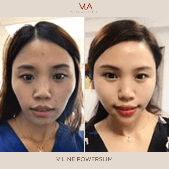 Injectable / V-Line Power Lift - Skin Perfect Brothers Powered by VLA
