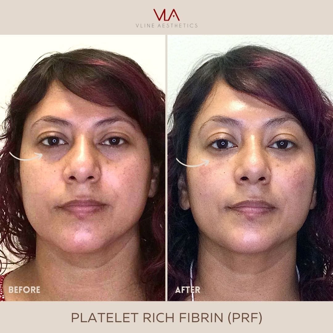 Platelet-Rich Fibrin (PRF) - Skin Perfect Brothers Powered by VLA