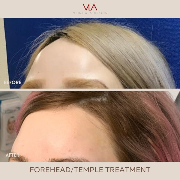 Temple Lift - Skin Perfect Brothers Powered by VLA