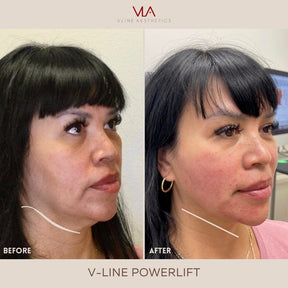 Juvéderm VOLUX XC - Skin Perfect Brothers Powered by VLA
