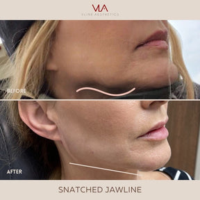 Juvéderm VOLUX XC - Skin Perfect Brothers Powered by VLA