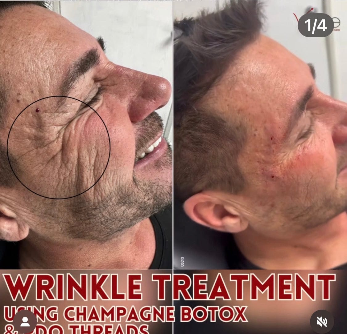 Champagne Botox - Skin Perfect Brothers Powered by VLA