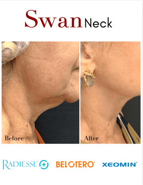 Swan Neck Package