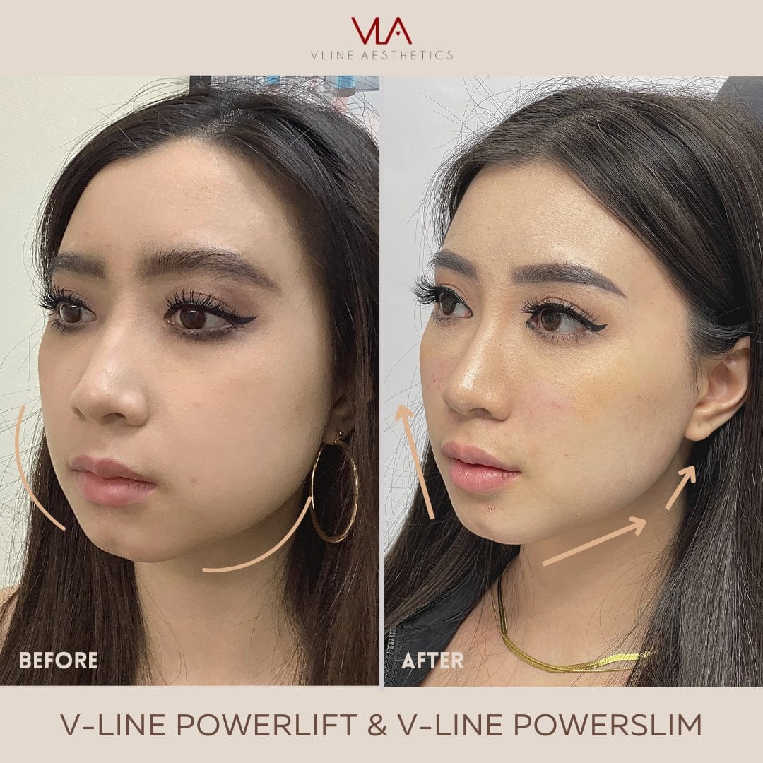 Collagen Lift - Skin Perfect Brothers Powered by VLA