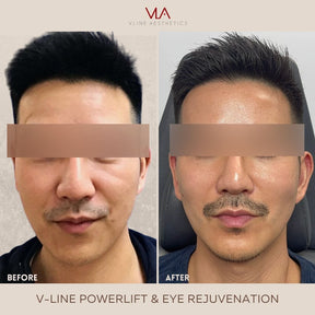 First Syringe of V-Line Power Lift - Skin Perfect Brothers Powered by VLA