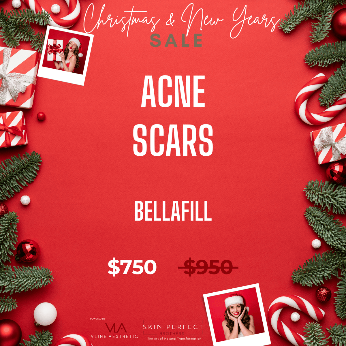 Acne Scars / 1 Bellafill