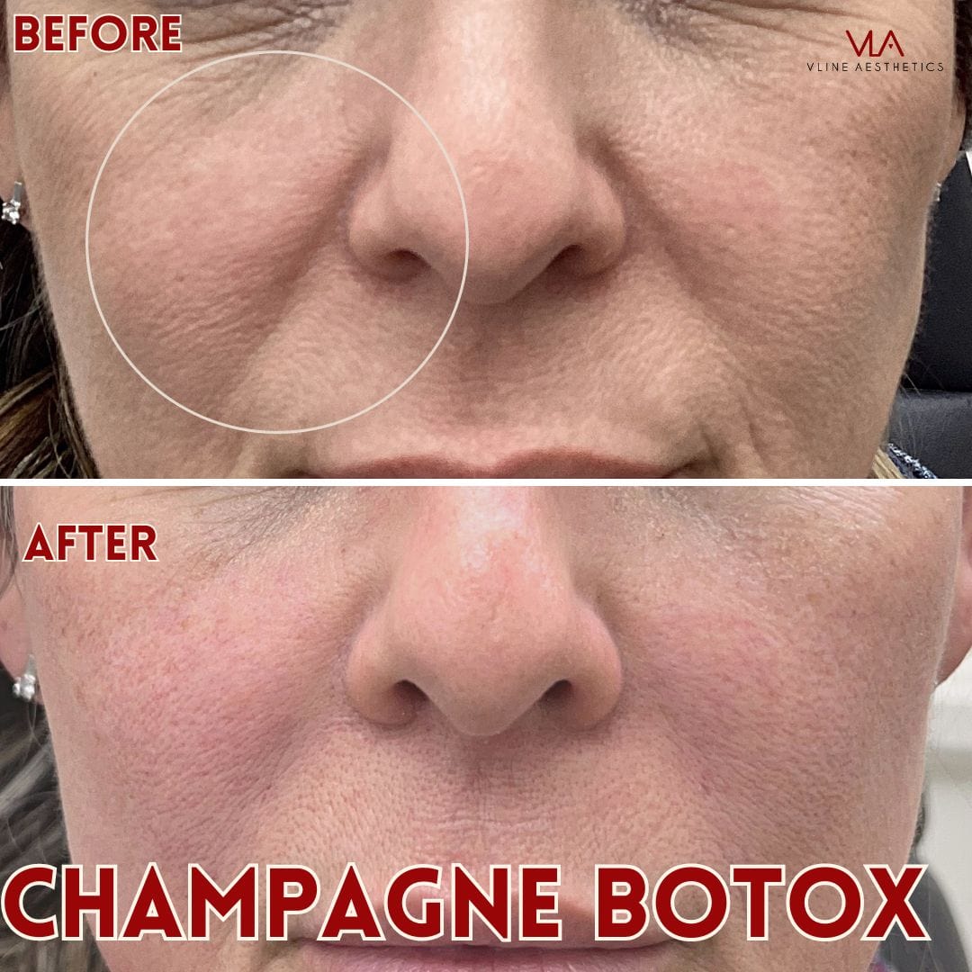 Champagne Botox - Skin Perfect Brothers Powered by VLA