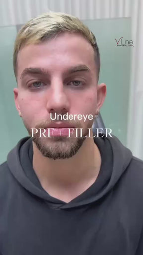 Vampire Eye Treatment - Platelet-Rich Fibrin (PRF)