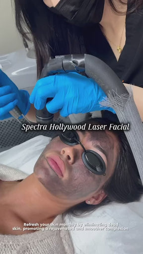 Melasma Laser Peel - Spectra Q Switch