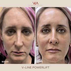 Collagen Lift