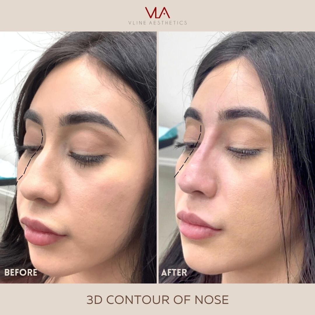 Non-Surgical Rhinoplasty - Skin Perfect Brothers Powered by VLA