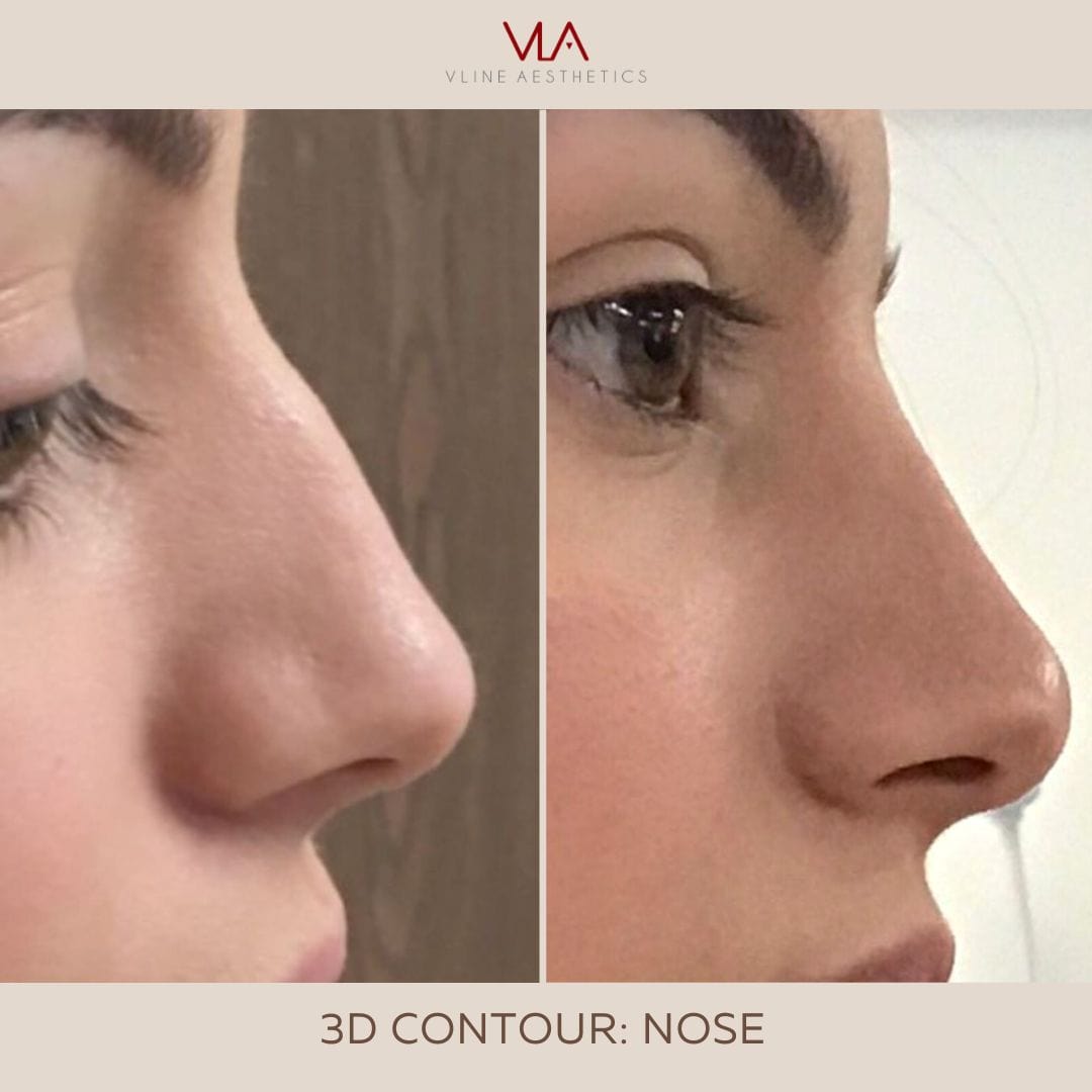 Non-Surgical Rhinoplasty / 1 Syringe of Juvederm Ultra Plus - Skin Perfect Brothers Powered by VLA