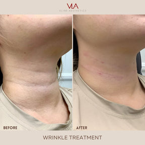 Neck Line Rejuvenation - Skin Perfect Brothers Powered by VLA