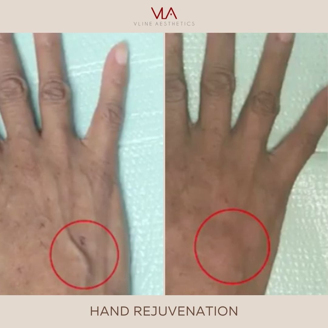 Hand Rejuvenation / 2 Radiesse - Skin Perfect Brothers Powered by VLA