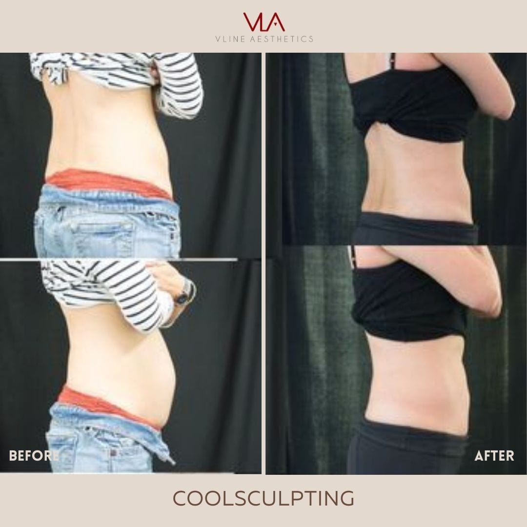 Coolsculpting | Body Sculpting - Skin Perfect Brothers Powered by VLA