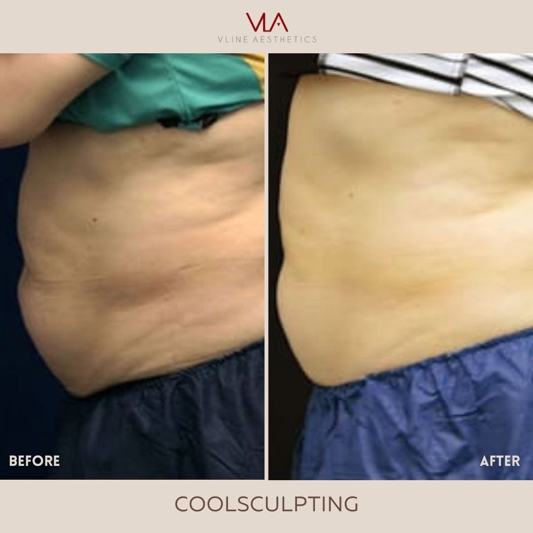 Coolsculpting | Body Sculpting - Skin Perfect Brothers Powered by VLA