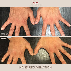 Hand Rejuvenation / 2 Radiesse - Skin Perfect Brothers Powered by VLA