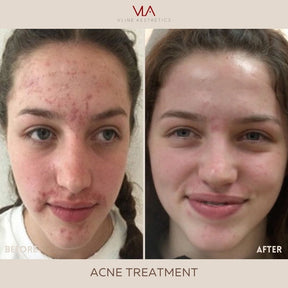 Acne scars, Wrinkles, Facial Rejuvenation / Laser Genesis + PMD Toner - Skin Perfect Brothers Powered by VLA